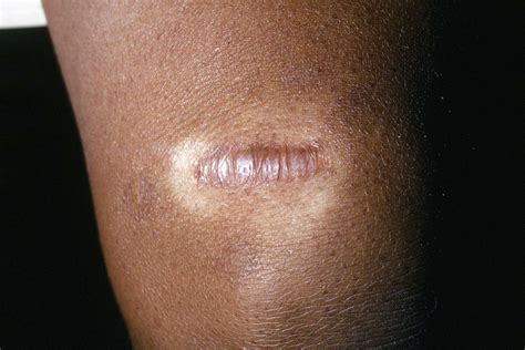 Keloid Scars: Risks, Causes, Prevention, and Treatment