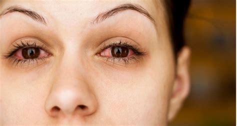 What Causes Red Eyes | Eye Solutions | Mumbai | Chennai