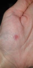 Wart help - using bazuka but it looks a bit wrong (photos) | Mumsnet