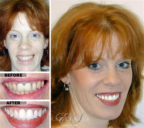 Gingivitis Before And After Treatment