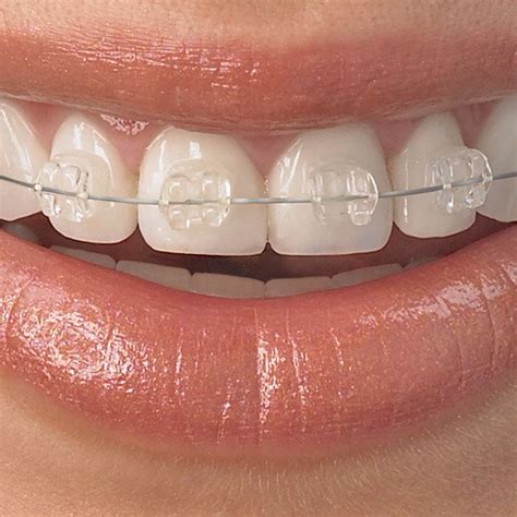 Clear braces – Artofit