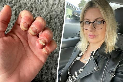 Woman points warning after years of gel nails: ‘I thought I would lose ...
