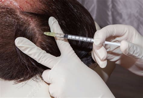 Alopecia Areata Treatment Bangalore | Alopecia Areata Natural Treatment