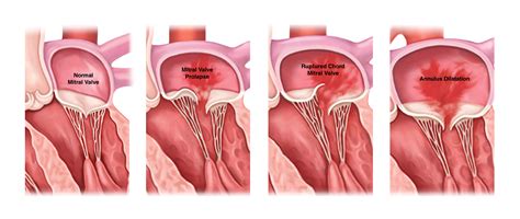 Mitral Valve Regurgitation Causes, Symptoms & Treatment