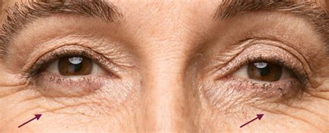 5 Questions Answered About Wrinkle Management Treatments