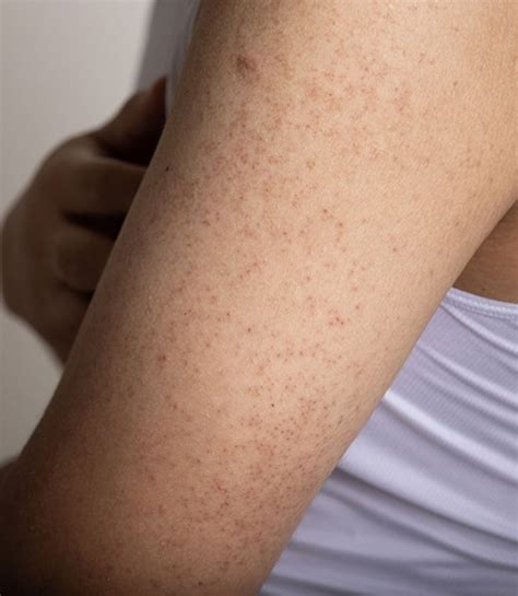 Staph infection: Causes, symptoms and treatment