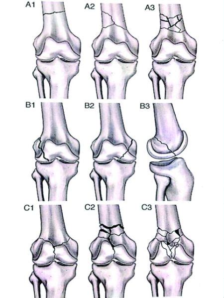 Distal Femoral Fractures: Complications and How to Avoid them? – Trauma ...