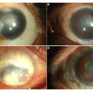 Causes of limbal stem cell deficiency. | Download Scientific Diagram