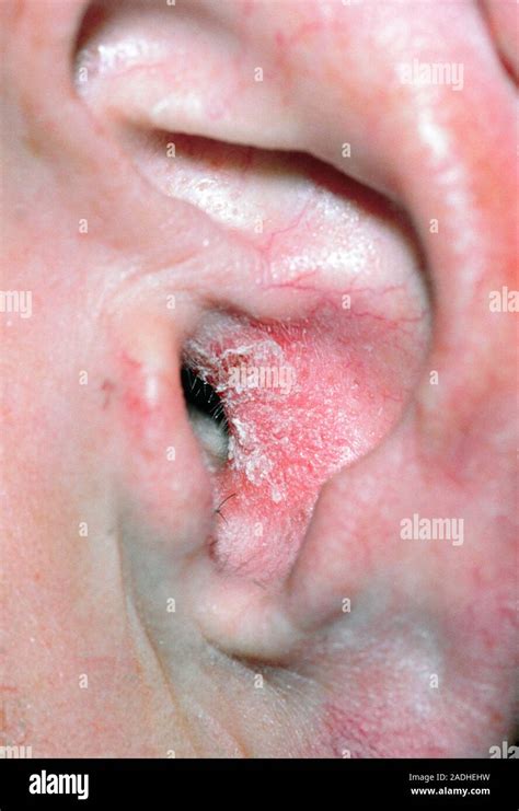 Eczema in the ear canal. The skin is red with yellowy-white scaly ...