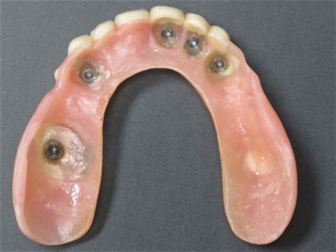 Tooth and Implant supported Over-dentures | Dr. Andrew Willoughby