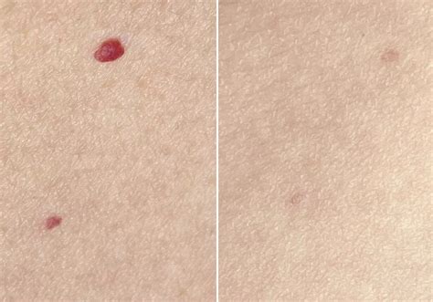 Cherry Angioma Removal - Loud Skin Clinic Westhoughton, Bolton ...