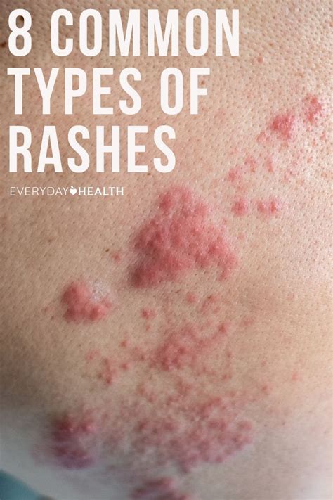 Different Types Of Skin Rashes