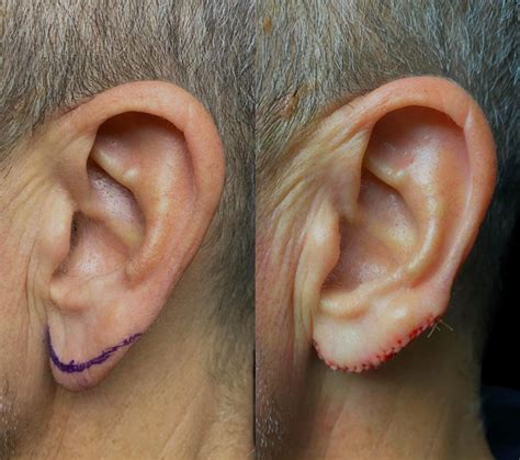 The Cosmetic Lane on Twitter: "Earlobe Rejuvenation Earlobes change with age—like anything else ...