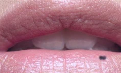 Black Spot on Lips? What’s That About Then? | HubPages