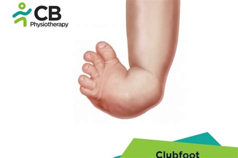 What is Clubfoot or Congenital Talipes Equinovarus or CTEV? Symptoms, Causes, Diagnosis ...