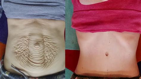 Parents Network Life: Diastasis Recti Surgery Covered By Insurance