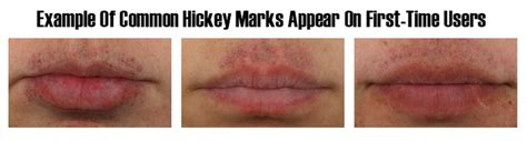 Can You Get Hickeys On Your Lips – Telegraph