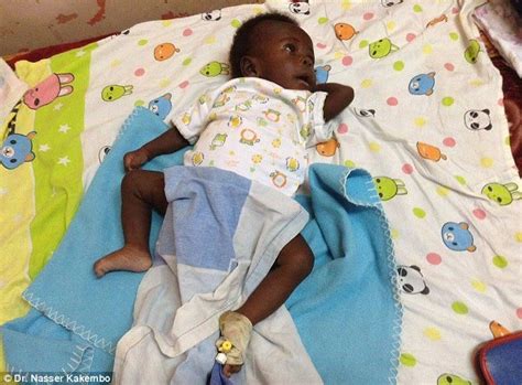 Eight limbed boy recovering well after surgery to remove his parasitic twin | Daily Mail Online