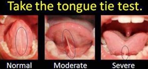 tongue tie Archives - Spectrum Chiropractic Natural Family Healthcare