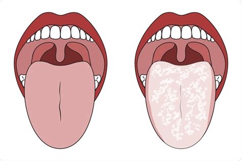 Oral Candidiasis Treatment