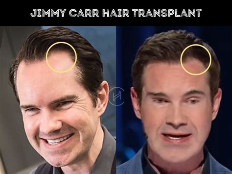 Jimmy Carr Hair Transplant - Hair Loss & Technical Analysis