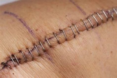 Wound care guideline (part 1) - Dressing overview