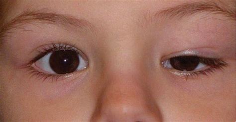 Ptosis signs and symptoms - Discover what they are!