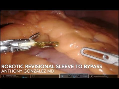 Robotic Revisional Gastric Bypass from previous Sleeve (twice) - YouTube