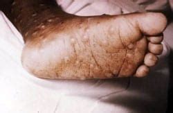 What is Smallpox? | Smallpox | CDC