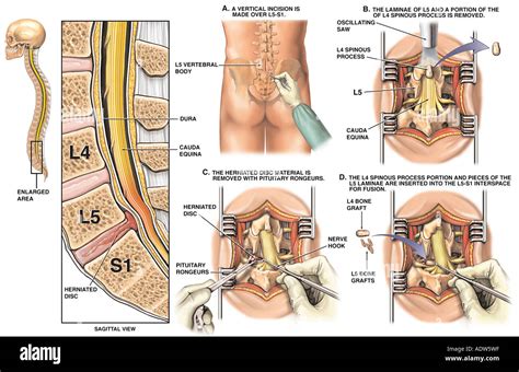 Lumbar laminectomy hi-res stock photography and images - Alamy