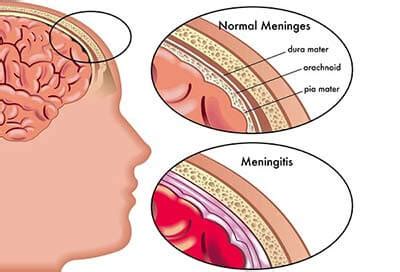 Meningitis Symptoms Stiff Neck