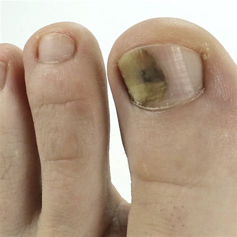 how to avoid toenail fungus - Toenail Fungus Treatment | Toenail Fungus ...