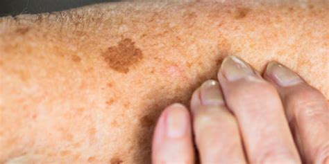 Skin Sunspots (Aka Age Spots): Causes, Prevention, and How to Get Rid of Them