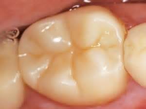 BruxZir Solid Zirconia Crowns and Bridges (3 yr.) – The Dental Advisor