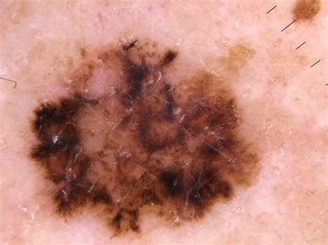 Skin Cancer Photos Melanoma