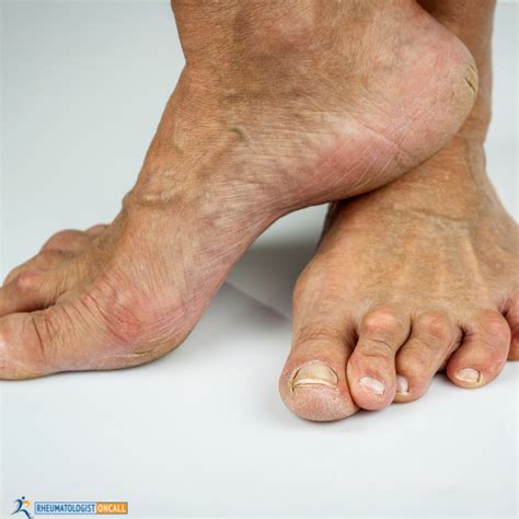 7 Devices For Arthritis Relief - To Help For Painful Feet