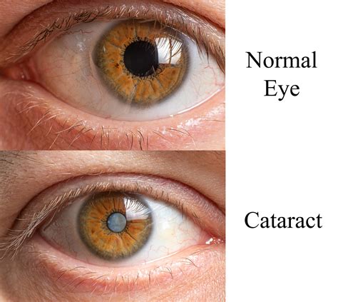 What to Expect from Cataract Surgery Recovery - LASIK Eye Surgery Grand Junction | Cataracts ...