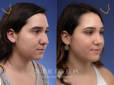 23 Year Old Lady Treated With Nosejob Photo With Dr. Steiger, Boca Raton, Florida (33432 ...