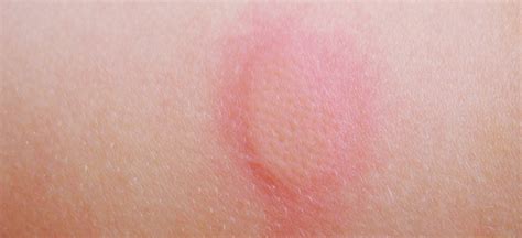 Erythema (+ 5 Natural Ways to Soothe Erythema Symptoms) - Dr. Axe