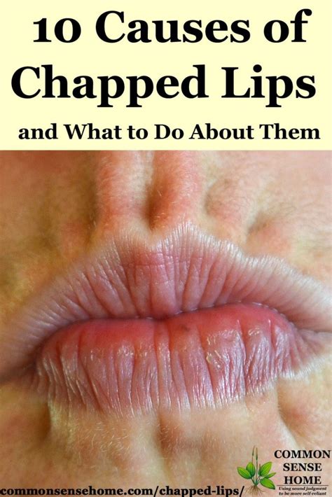 10 Causes of Chapped Lips, Plus How to Get Rid of Chapped Lips