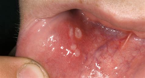 White Spots On Inside Of Lips Nhs | Sitelip.org