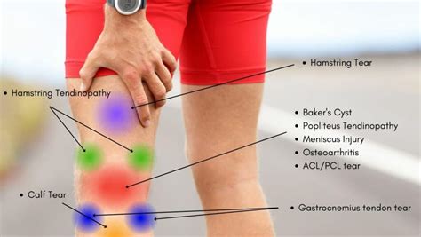 Knee Pain Location Chart | Learn the Pain Location of Knee Injuries