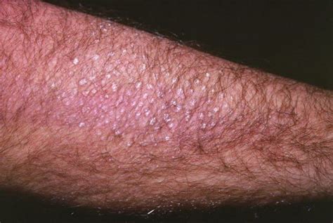 Image: Cutaneous Lichen Amyloidosis (Arm) - MSD Manual Consumer Version