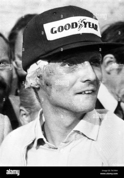 Niki Lauda after his skin grafting operation following his crash in the 1976 German Grand Prix ...