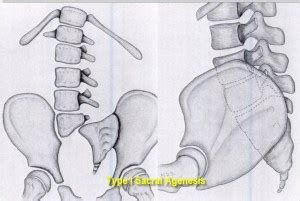 Sacral Agenesis | Bone and Spine