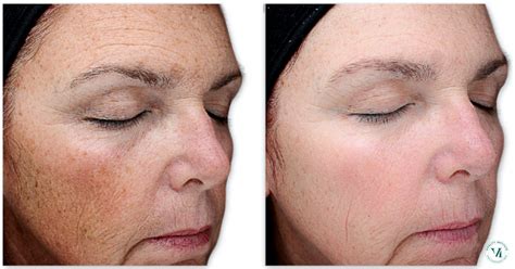 VI Peel Precision Plus - Renew Dermatology - Birmingham AL based ...