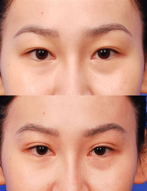 Asian Blepharoplasty | Double Eyelid Surgery - San Diego — SKY Facial Plastic Surgery
