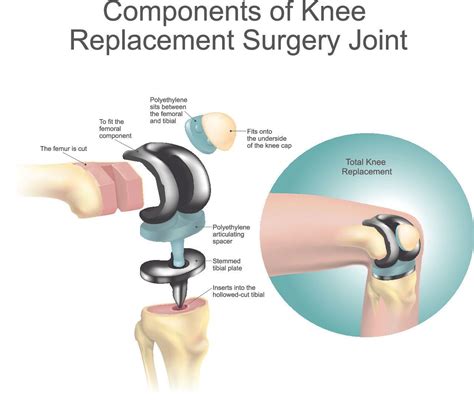 Total Knee Replacement (TKR) | Dr A. Theodorides Knee Surgeon Specialist