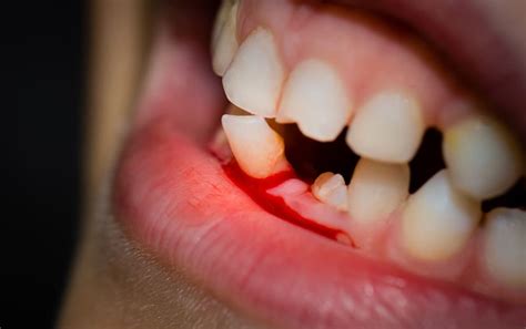 Dream About Teeth Falling Out With Blood? (6 Spiritual Meanings)