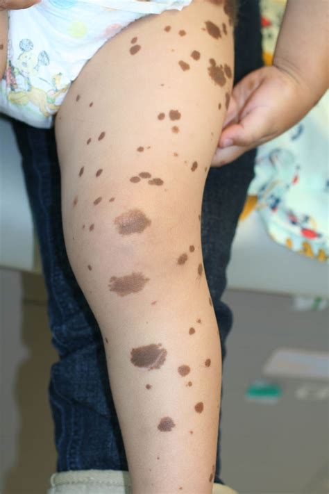 Neurocutaneous Melanosis (Neurocutaneous melanocytosis) - Dermatology Advisor